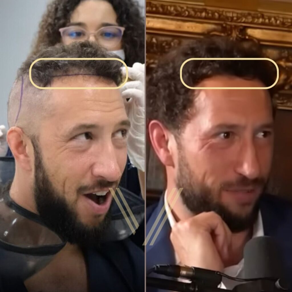 mike majlak hair transplant before after