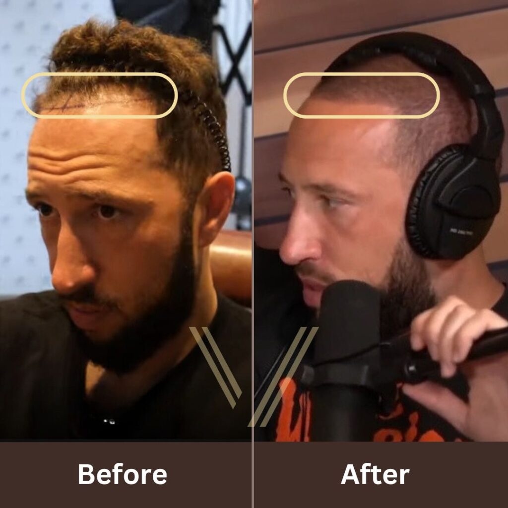Mike Majlak Before and After Hair Transplant