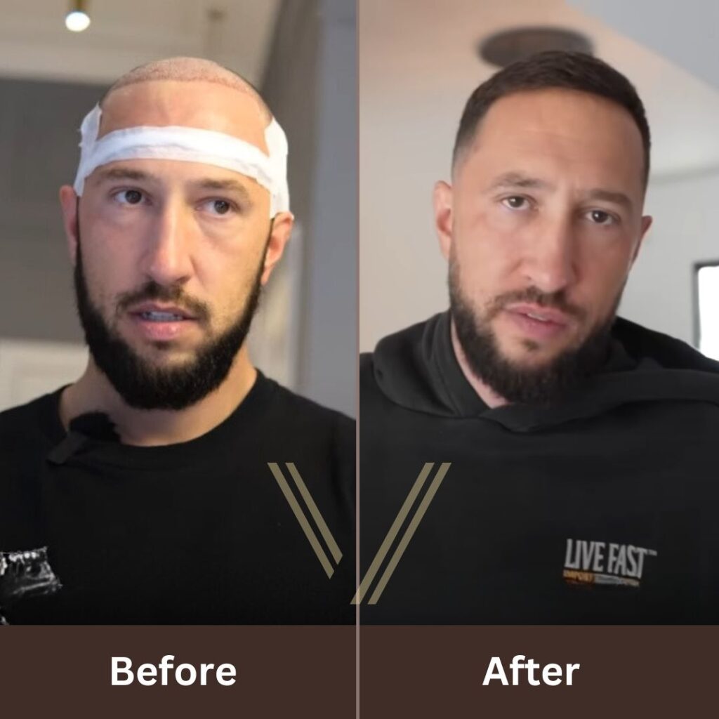 Mike Majlak Before and After Hair Transplant