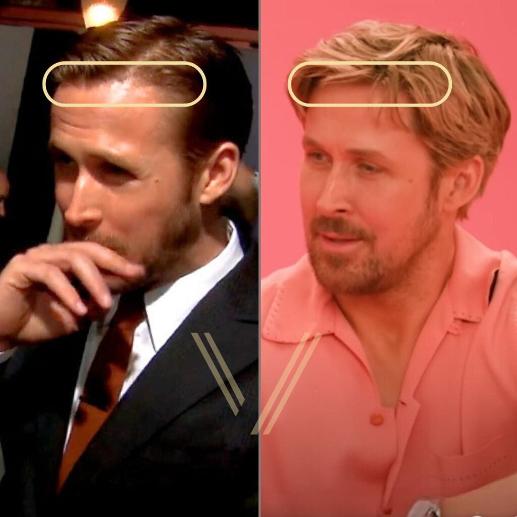 ryan gosling hair transplant before after result