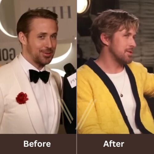 ryan gosling hair transplant before and after result