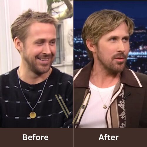 ryan gosling hair transplant before and after result
