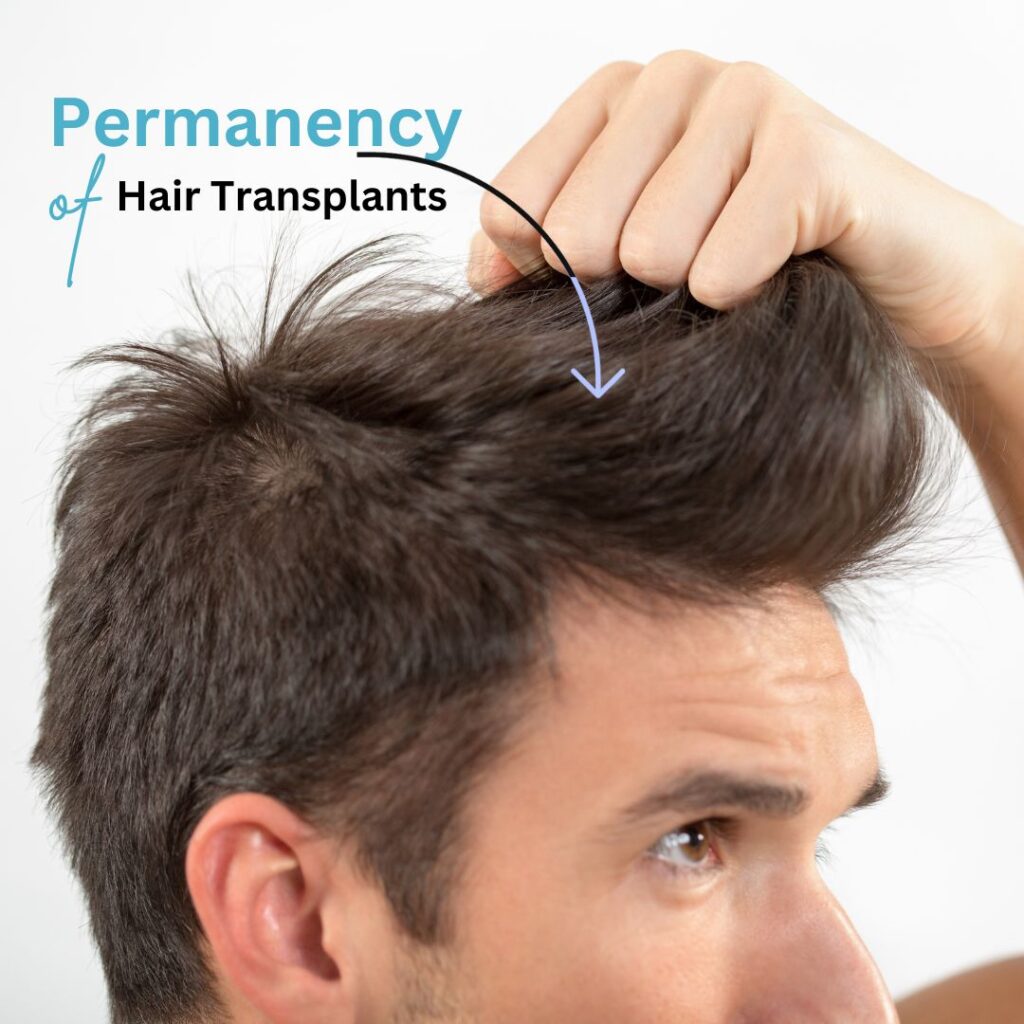 Permanency of Hair Transplants