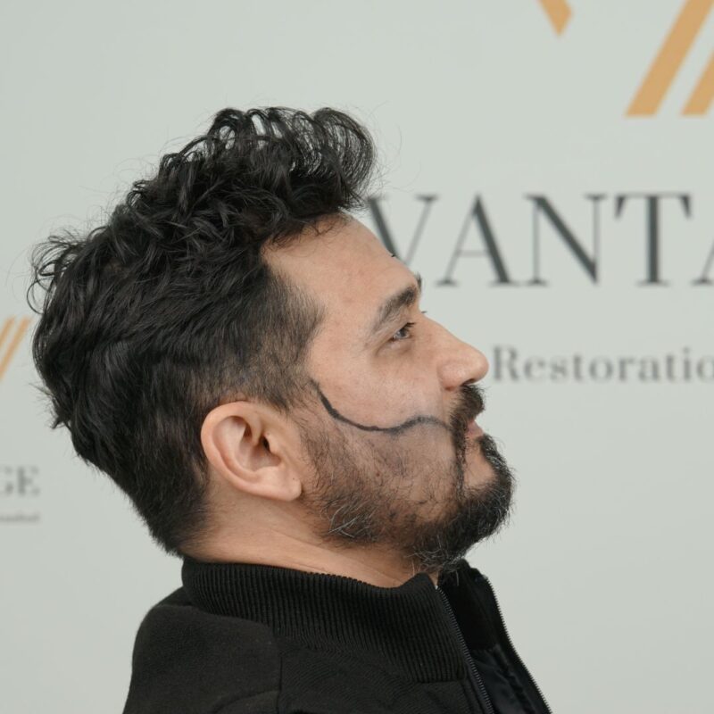 beard to head hair transplant
