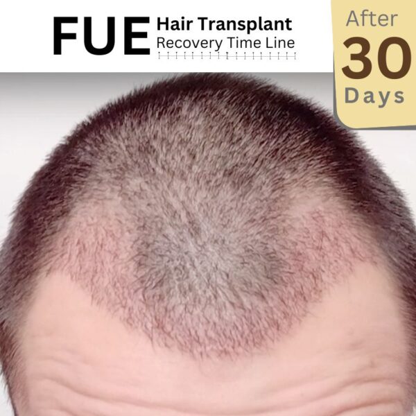 After 30 days fue hair transplant