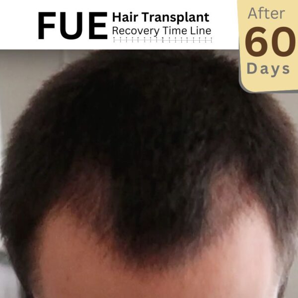 After 60 days fue hair transplant