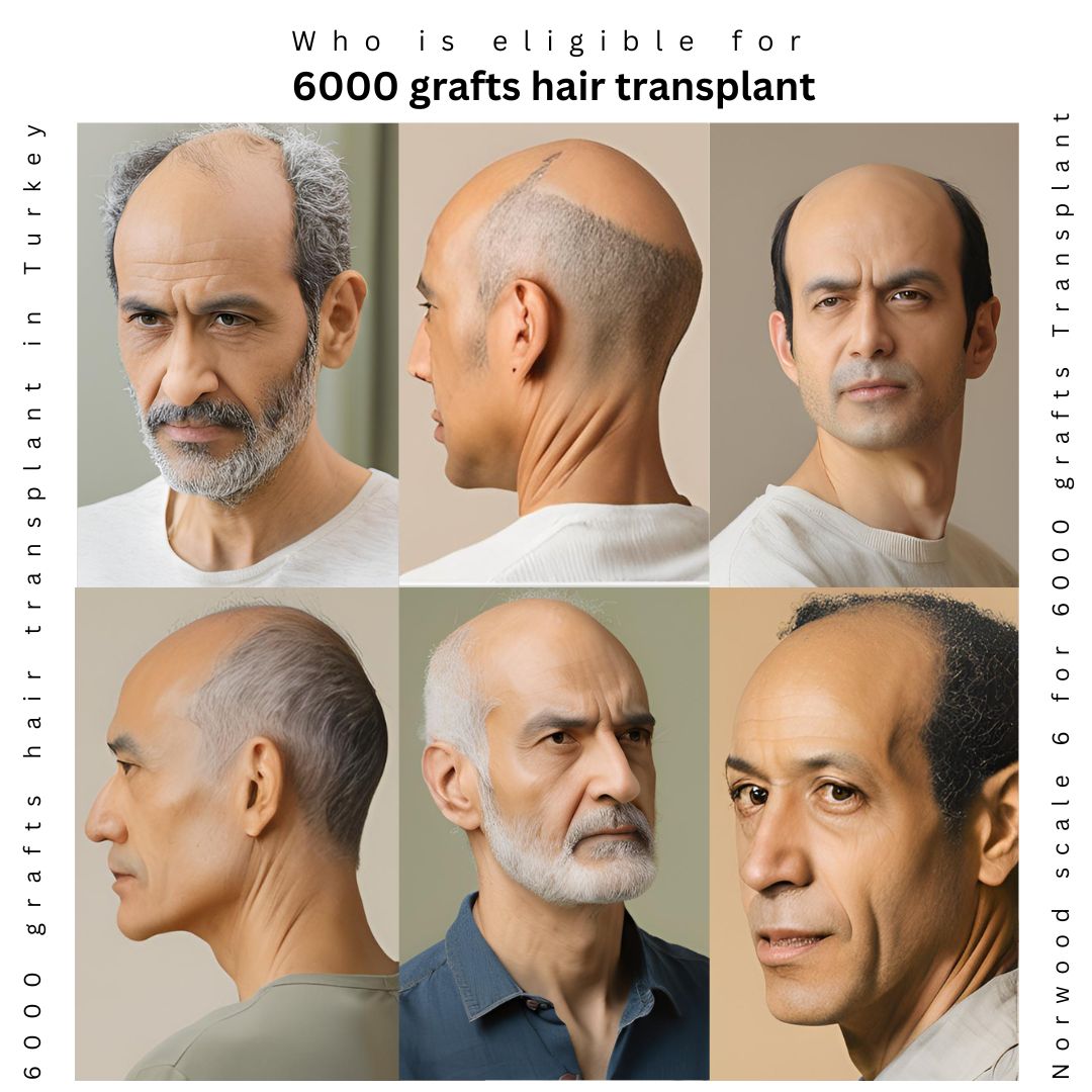 Eligibility for 6000 Grafts Hair Transplant