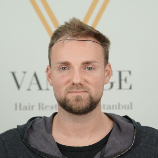 Microfit hair transplant benefits