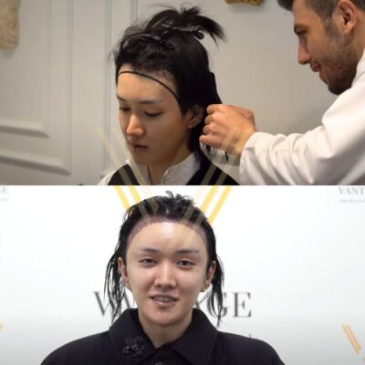 Unshaven hair transplant Turkey