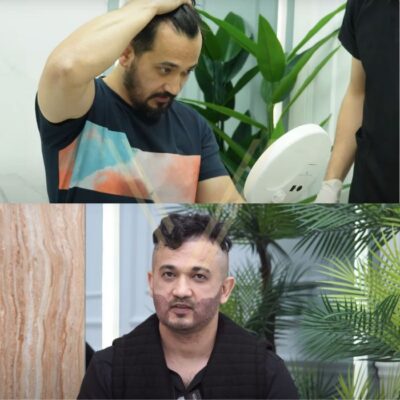Unshaven hair transplant Turkey