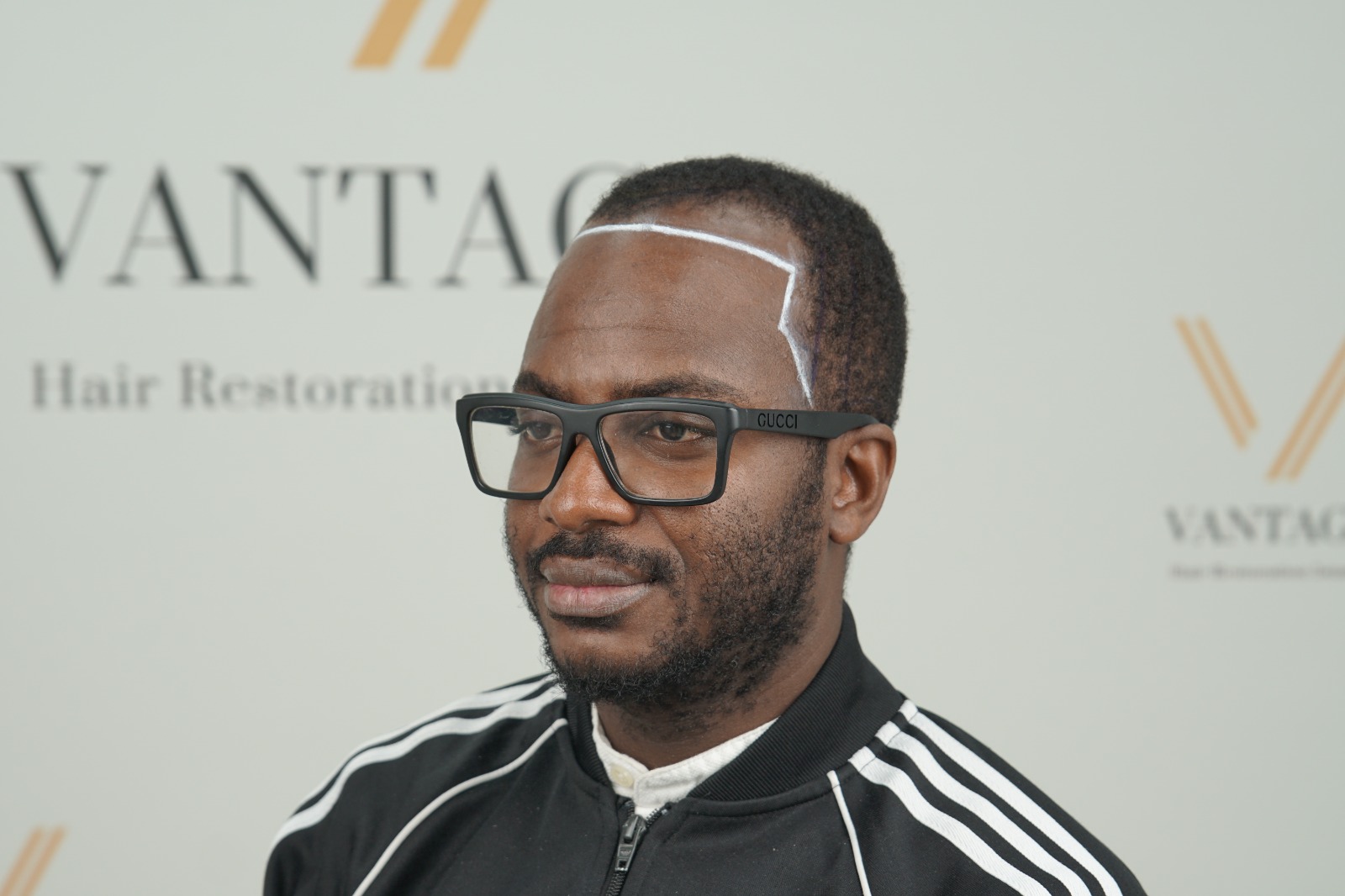 hair transplant in turkey