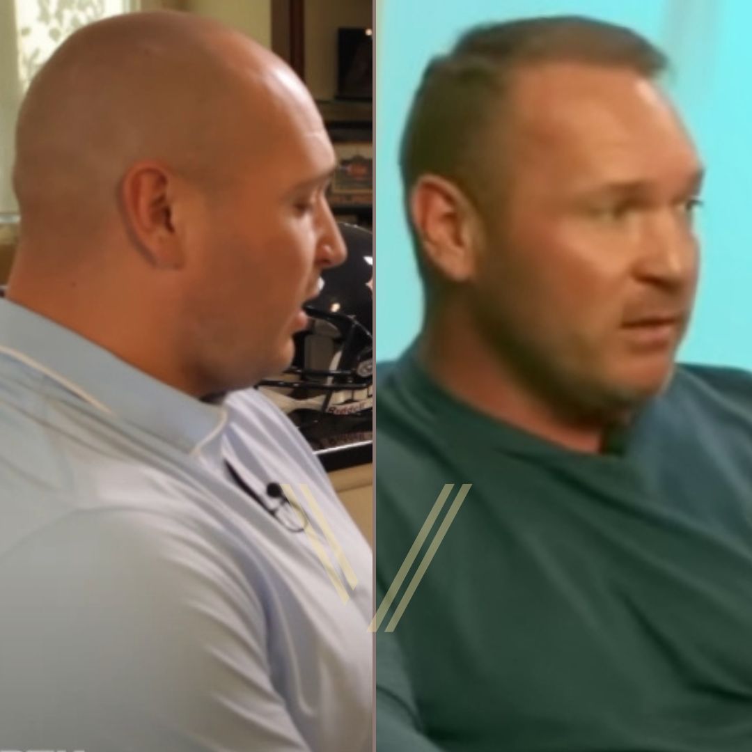 Brian Urlacher Hair Transplant