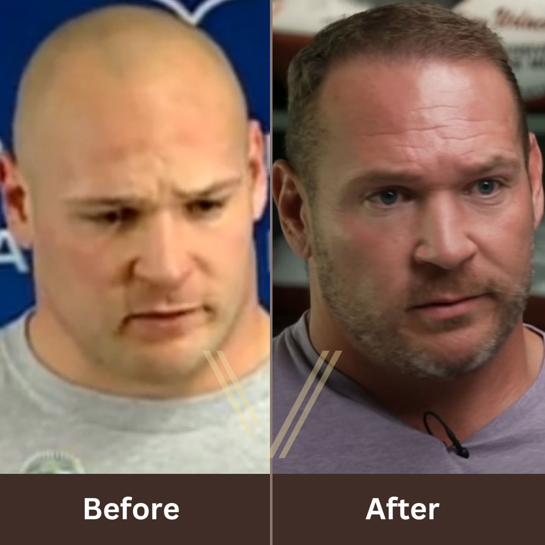 Brian Urlacher Hair Transplant
