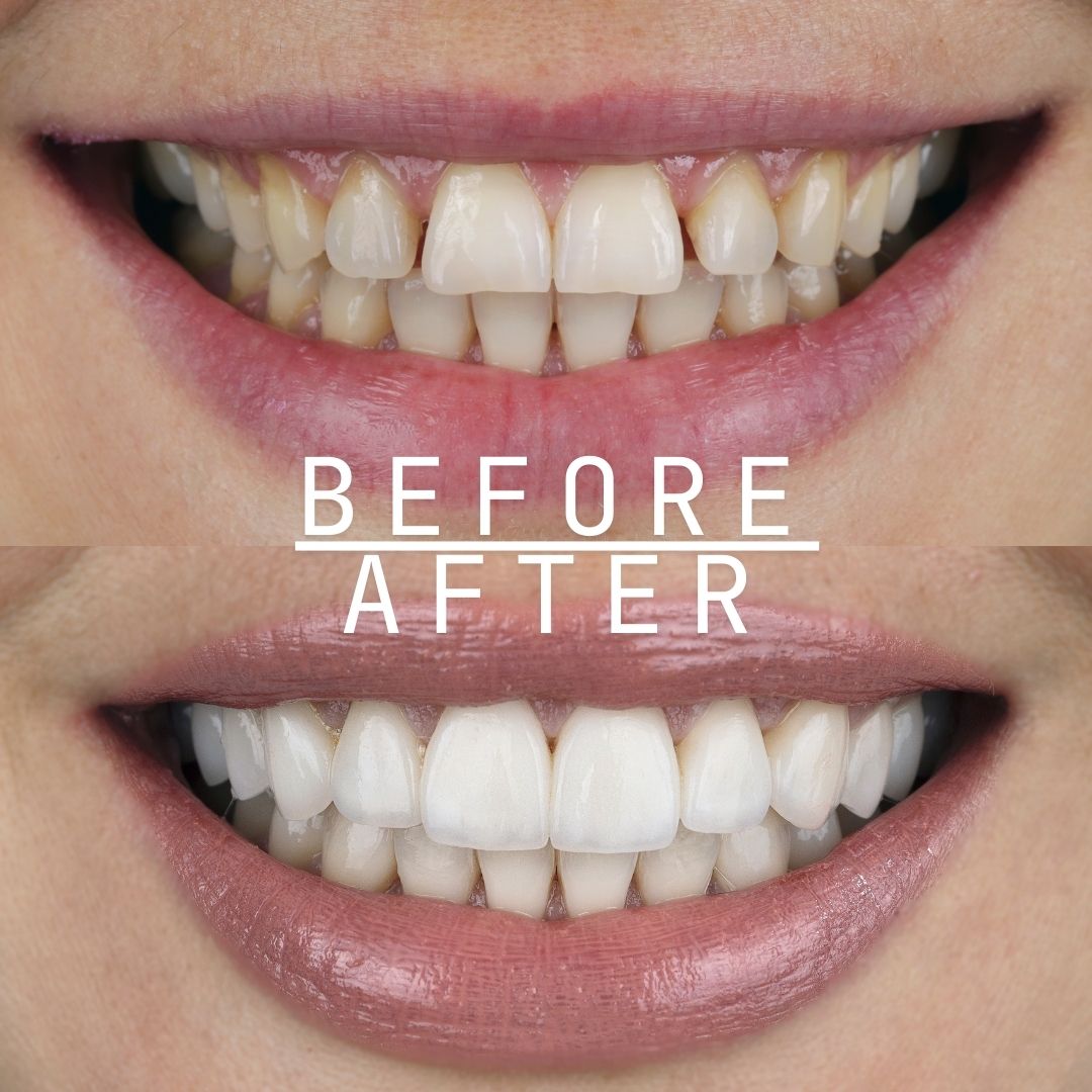 hollywood smile before and after