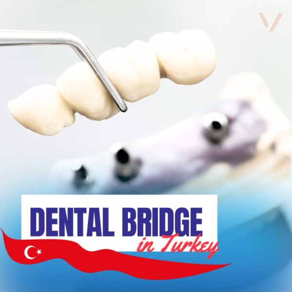 dental bridge in turkey