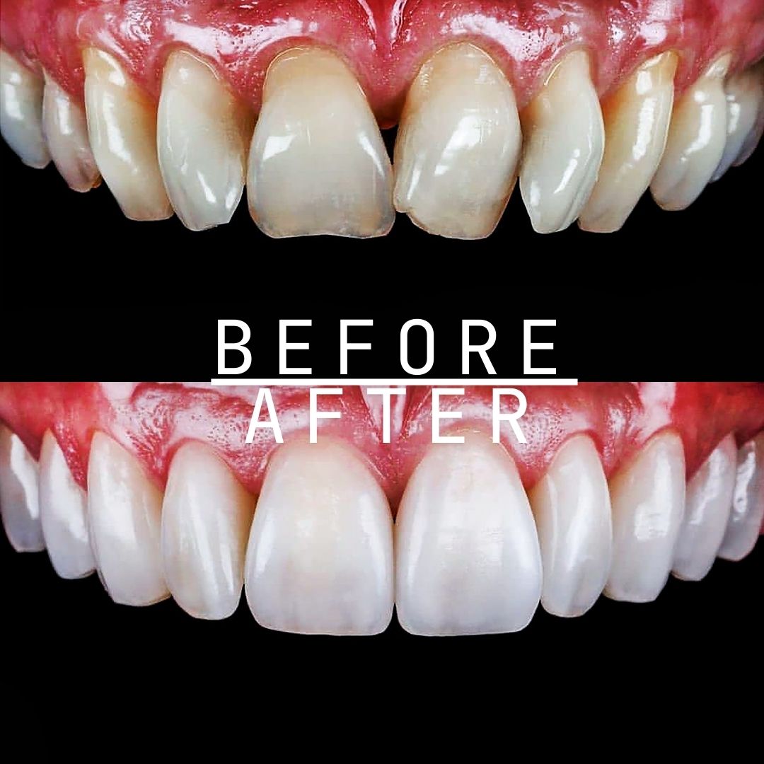 dental veneers before and after