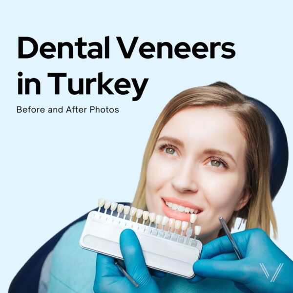 dental veneers in turkey